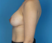 after breast augmentation left side view case 3098
