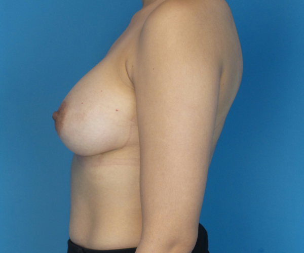 after breast augmentation left side view case 3098