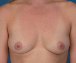 before breast augmentation front view case 3109