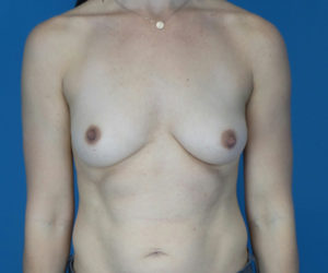 before breast augmentation front view case 3120