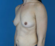 before breast augmentation left angled view case 3120