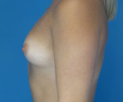 before breast augmentation left side view case 3131
