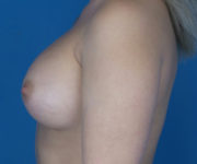 after breast augmentation left side view case 3131