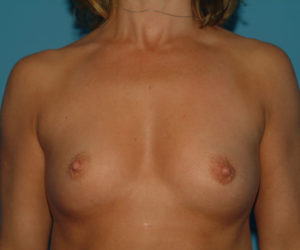 before breast augmentation front view case 3154