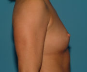 before breast augmentation right side view case 3154