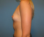 before breast augmentation left side view case 3162