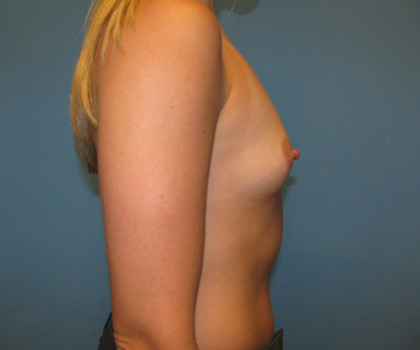 before breast augmentation right side view case 3162
