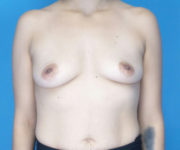 before breast augmentation front view case 3098