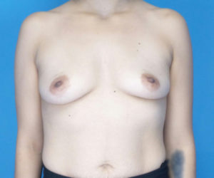 before breast augmentation front view case 3098