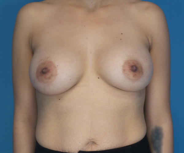 after breast augmentation front view case 3098