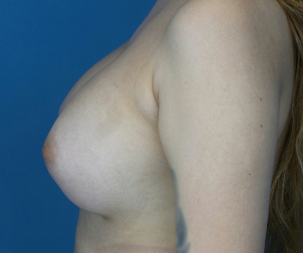 after breast augmentation left side view case 3060