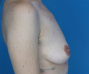 before breast augmentation right side view case 3051