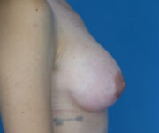after breast augmentation right side view case 3051