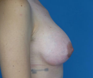 after breast augmentation right side view case 3051