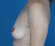 before breast augmentation left side view case 3051