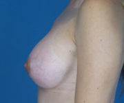 after breast augmentation left side view case 3051