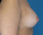 after breast augmentation right side view case 2938