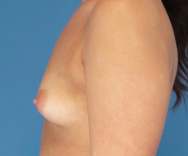 before breast augmentation left side view case 2938