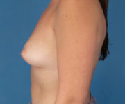 before breast augmentation left side view case 3596