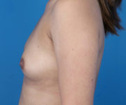before breast augmentation left side view case 3607