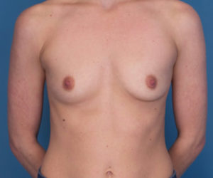 before breast augmentation front view case 3612