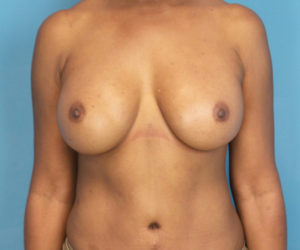 after breast augmentation front view case 3642