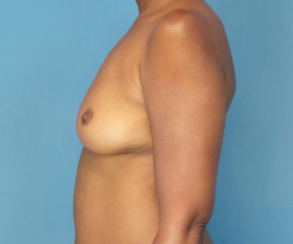 before breast augmentation left side view case 3642