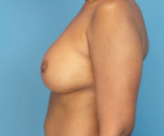 after breast augmentation left side view case 3642