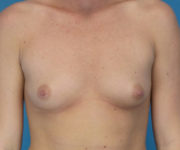 before breast augmentation front view case 3653