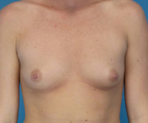 before breast augmentation front view case 3653