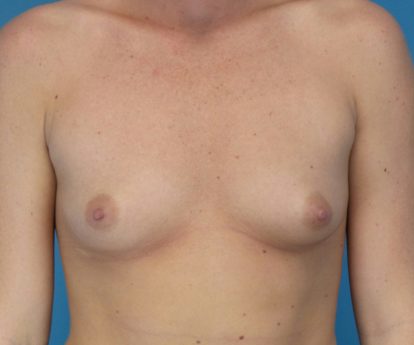 before breast augmentation front view case 3653