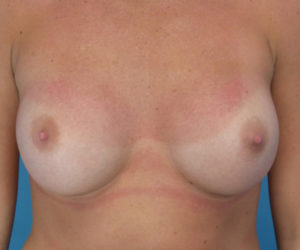 after breast augmentation front view case 3653