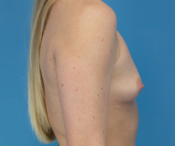 before breast augmentation right side view case 3653