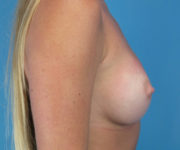 after breast augmentation right side view case 3653