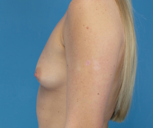 before breast augmentation left side view case 3653