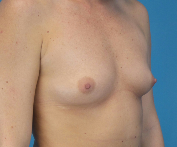 before breast augmentation right angled view case 3653 | Crispin Plastic Surgery Atlanta, GA