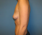 before breast augmentation left side view case 3700