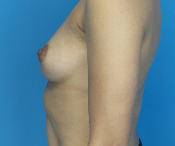 before breast augmentation left view case 3719 | Crispin Plastic Surgery Atlanta, GA