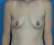 before breast augmentation front view female patient case 3748