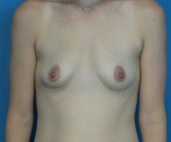 before breast augmentation front view female patient case 3748