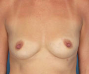 before breast augmentation front view female patient case 3755