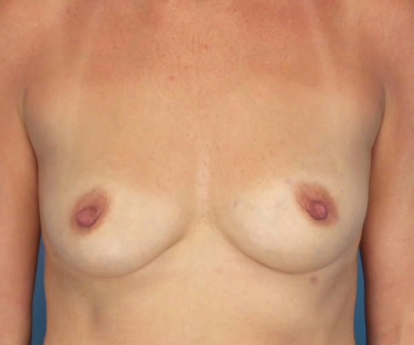 before breast augmentation front view female patient case 3755