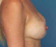 after breast augmentation right side view female patient case 3755