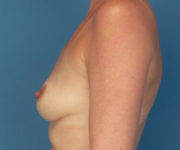 before breast augmentation left side view female patient case 3755