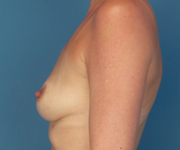 before breast augmentation left side view female patient case 3755