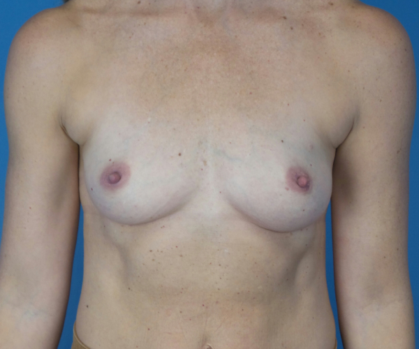 before breast augmentation front view female patient case 3777