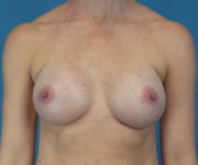 after breast augmentation front view female patient case 3777