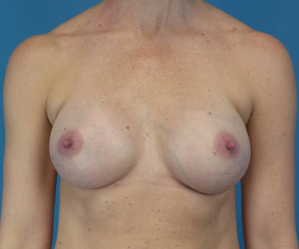 after breast augmentation front view female patient case 3777