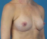 after breast augmentation right angle view female patient case 3777