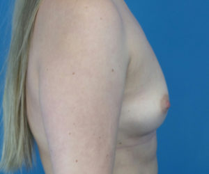 before breast augmentation right side view case 3788